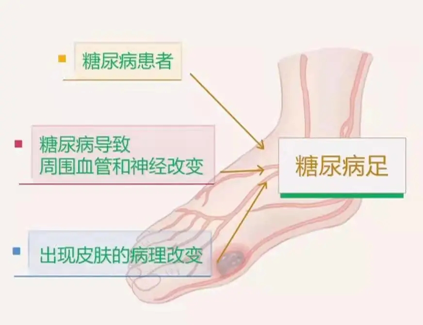 糖尿病足病知多少