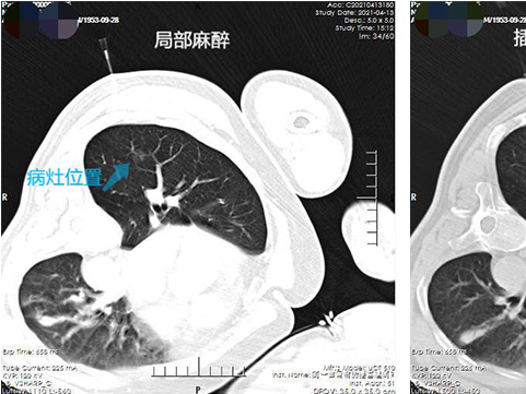 肺結(jié)節(jié)治療不開胸 射頻消融術(shù)治療效果好