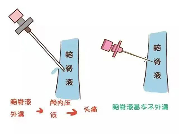 麻醉手術(shù)后不需要去枕平臥了 你知道嗎？