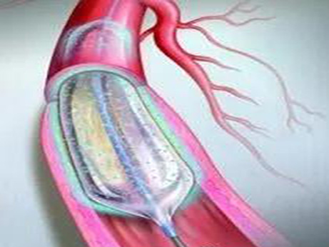 技術(shù)更新|支架之外的新選擇——看不見(jiàn)的“藥物球囊”