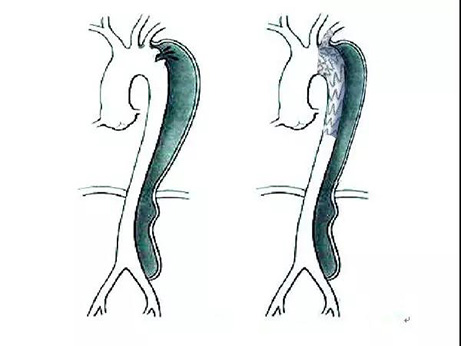 【特別關(guān)注】我院成功完成主動(dòng)脈夾層腔內(nèi)修復(fù)術(shù)一例，填補(bǔ)遼西空白