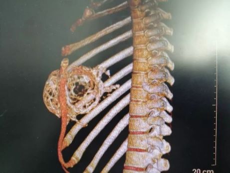 1例16厘米巨大肋骨骨巨細胞瘤被成功切除