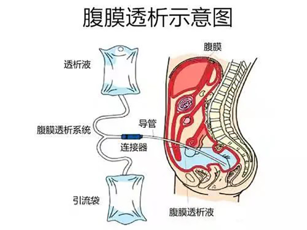 堅(jiān)持高質(zhì)量發(fā)展 創(chuàng)遼西腹膜透析旗艦品牌