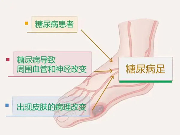 優(yōu)勢學(xué)科｜糖尿病足 預(yù)防大于治療 隨訪同樣重要