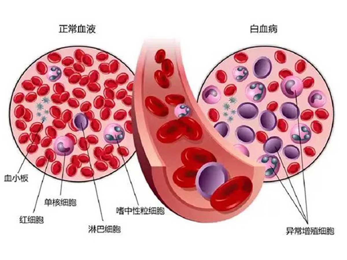 優(yōu)勢(shì)學(xué)科｜多學(xué)科合作 個(gè)體化治療 為老年高危急性髓系白血病合并壞疽性膿皮病患者帶來(lái)希望