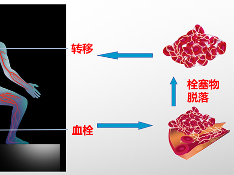 優(yōu)勢學(xué)科|錦州市中心醫(yī)院心血管內(nèi)三科成功救治一名高危肺動脈栓塞患者