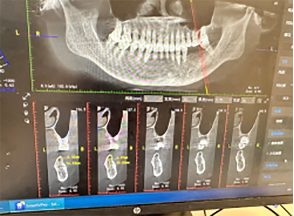 優(yōu)勢(shì)技術(shù) | 骨增量技術(shù) 擴(kuò)大種植牙修復(fù)適應(yīng)證 提高手術(shù)成功率
