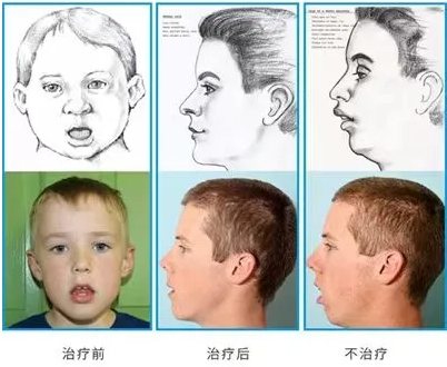 優(yōu)勢技術 | 兒童口腔健康及牙齒咬合 早期矯正事半功倍