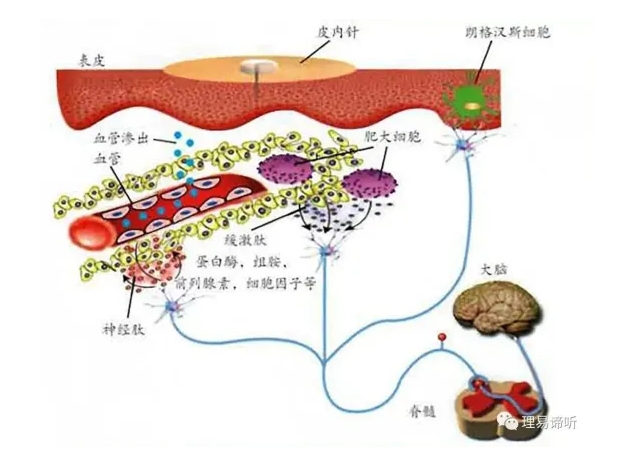 中醫(yī)治療| 小“圖釘”大妙用——撳針療法